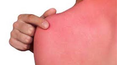 أستاذ جلدية: أطفال الريف والسواحل هم الأكثر عرضة لحروق الشمس بفصل الصيف