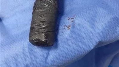 بنها الجامعي ينجح في استخراج هاتف محمول من معدة شاب بالقليوبية | صور 