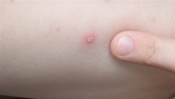 جدري القرود