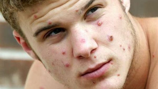 جدري القرود