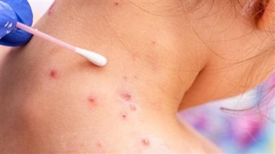 للحد من انتشاره.. الصحة تكشف إجراءات التعامل مع القادمين من الدول الموبوءة بجدري القرود | بث مباشر