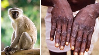 بينتقل عبر العلاقات الجنسية.. تفاصيل انتشار جدري القرود وطرق الوقاية منه | فيديو