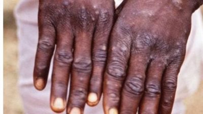 التشيك ترصد أول حالة إصابة بـ جدري القرود