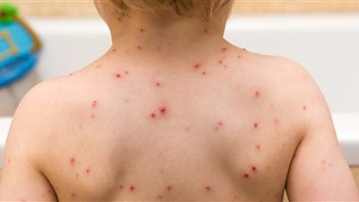 بريطانيا تعلن اكتشاف 7 حالات إصابة جديدة بجدري القرود