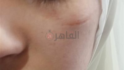 حاولت مقاومته.. طالبة تتهم شابًا بالتعدي عليها بالضرب والتحرش بها في الغربية | صور