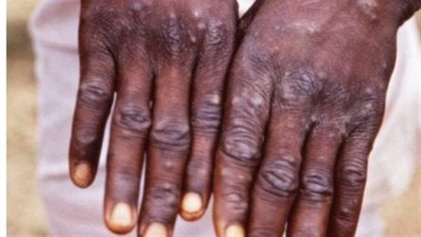 جدري القرود