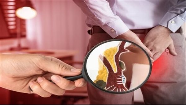 علاج البواسير