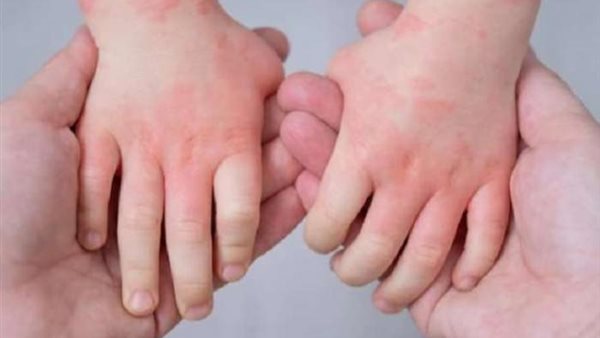 انفلونزا الطماطم