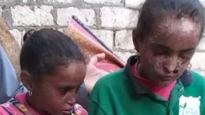 والد طفلتين مصابتين بمرض نادر بسوهاج: مبيخرجوش من البيت.. نفسي يتعالجوا وأشوفهم أحسن ناس | بث مباشر