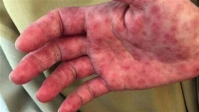 أستاذ علم أوبئة: أنفلونزا الطماطم غير مميتة وتنشط مع قلة نظافة الطفل