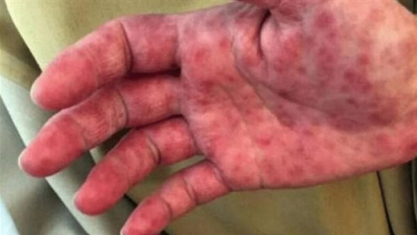 انفلونزا الطماطم