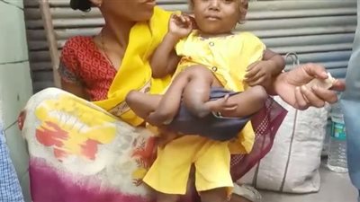 حالة نادرة.. ظهور طفلة هندية بذراعين وساقين على خصرها