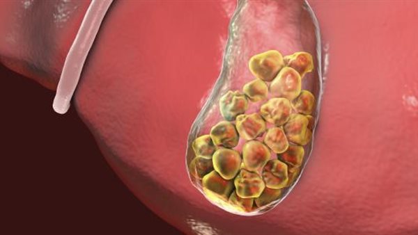 حصوات الكلى