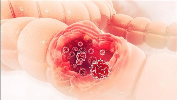 سرطان القولون 