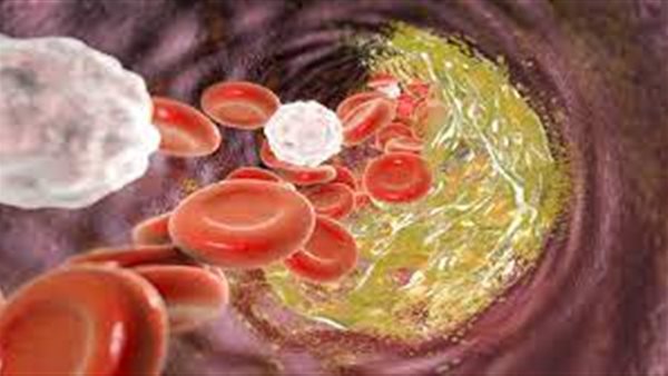 الكوليتسرول 