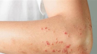 الحكومة تكشف إجراءات التأهب لانتشار جدري القرود