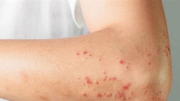  مرض جدري القردة