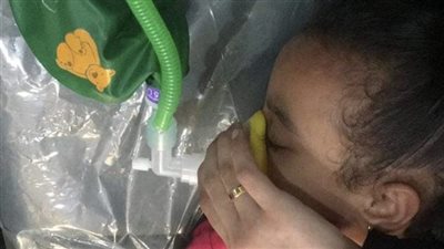 نصف جنيه.. مستشفى كفر الدوار ينجح في استخراج عملة معدنية من حنجرة طفلة | صور