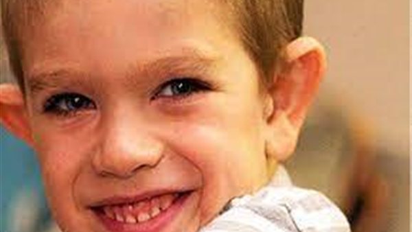 متلازمة الهش