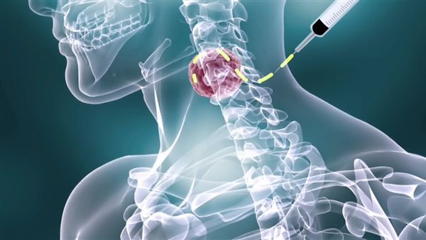 سرطان الغدد الليمفاوية