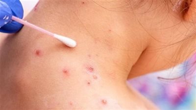 ألمانيا تسجل حالة جديدة بفيروس جدري القرود