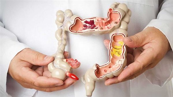 علاج القولون