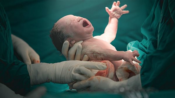 الولادة القيصرية