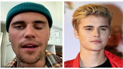 بعد إصابة جاستين بيبر بها.. تعرف على متلازمة رامزي هانت