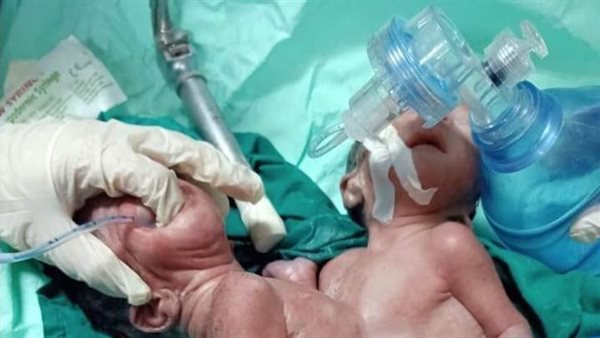 تؤام متلاصق بأسيوط