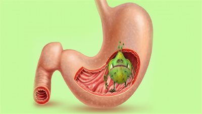 أعراض جرثومة المعدة العضوية والنفسية.. احذر البراز الدموي