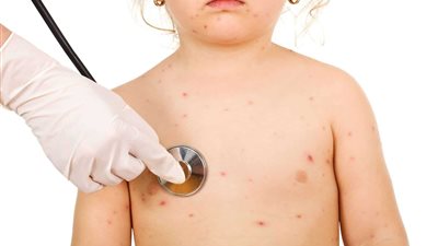 منهم العصبية الشديدة..علامات مرضية حديثة تشير إلى إصابة طفلك بجدري الماء