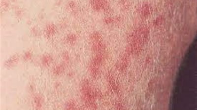 دراسة: البكتيريا المسببة للتيفود أصبحت مقاومة للمضادات الحيوية