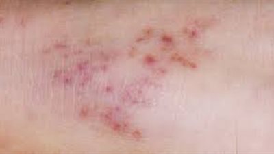 بعد انتشاره في فلوريدا.. تحذيرات من مرض المكورات السحائية: مميت والتطعيم وحده لا يكفي لمواجهته