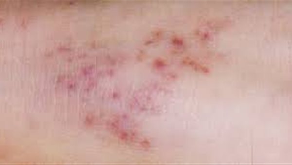 مرض المكورات السحائية