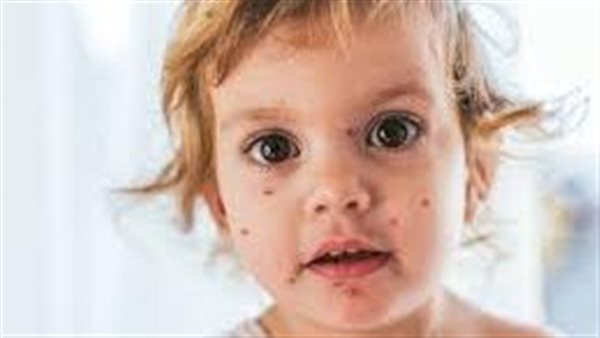 الهربس الفموي