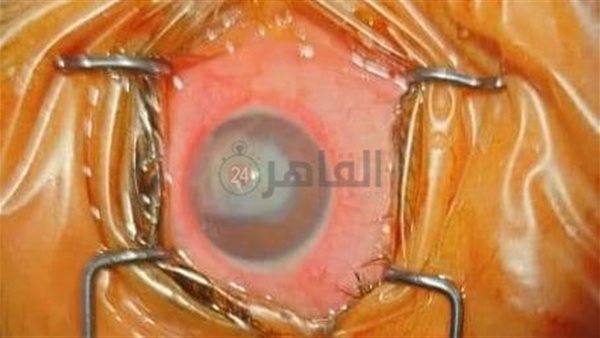 زراعة قرانية كامله