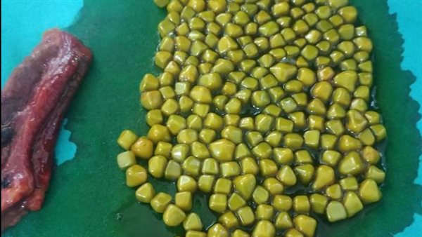 عدد كبير من الحصوات