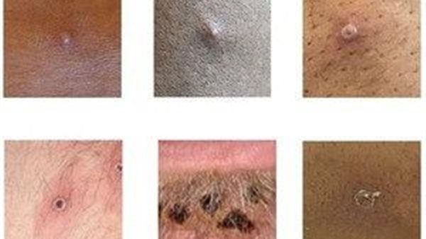 جدري القرود