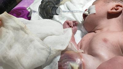 عندي أمل ابني يعيش.. أب يستغيث لعلاج طفله المصاب بعيب خلقي ويحتاج لتدخل جراحي