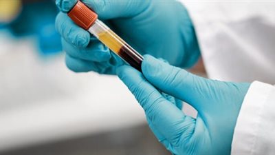 دراسة: اختبارات الدم يمكنها التنبؤ بالمخاطر المستقبلية للإصابة بـ اللوكيميا