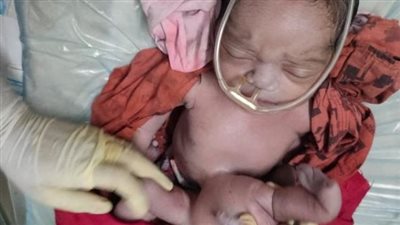 ليست الأولى.. ولادة طفل غريب المظهر في الهند