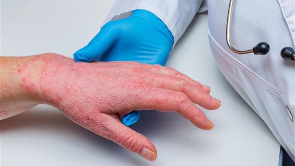 جدري القرود 