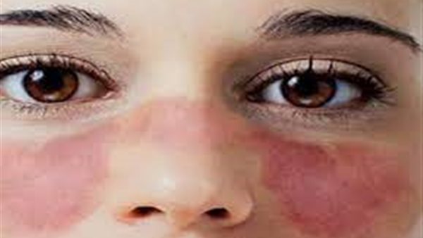 الذئبة الحمراء