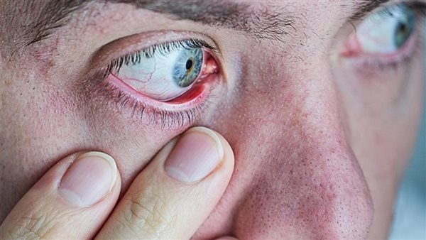 ترطيب العين