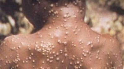 الصحة الأمريكية: ولاية تكساس تتجاوز 1000 إصابة بجدري القرود