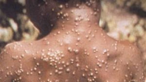 جدري القرود 