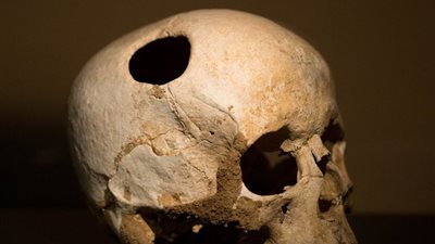 ديلي ميل: إنقاذ مرضى إصابات الدماغ يتم بفضل عملية الطراز المصري القديم