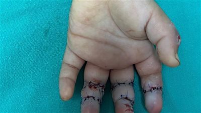 إنقاذ يد طفلة من البتر أدخلتها في مفرمة لحمة بطنطا 