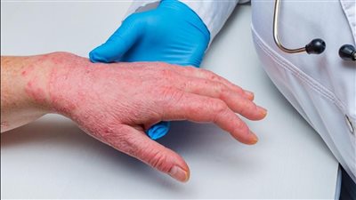 نصائح طبية بشأن التعامل مع جدري القرود.. تعرف عليها