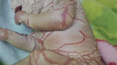 بعد نشر “القاهرة 24” الاستغاثة.. مجلس الوزراء يتدخل لعلاج “طفلة الشمع” (صورة)